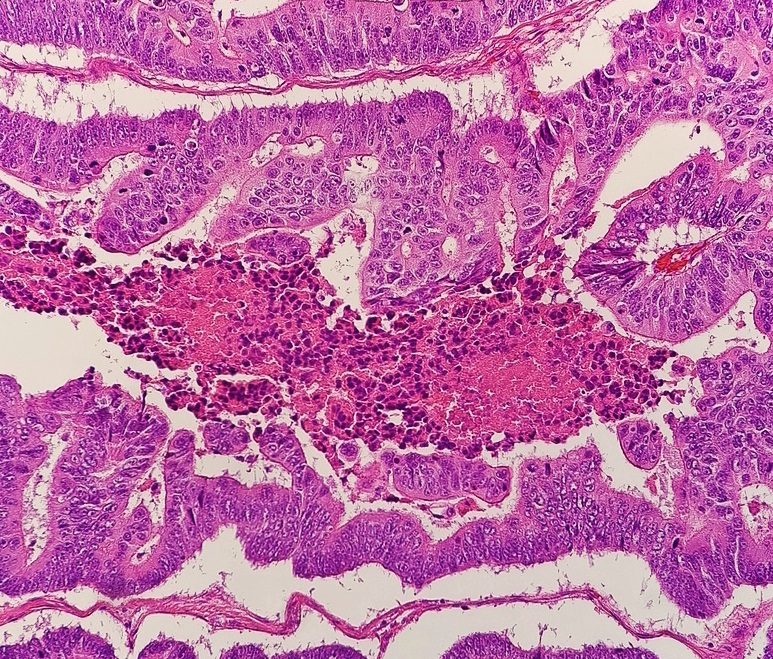Adenocarcinoma â€” colon — Glandular, H&E stain