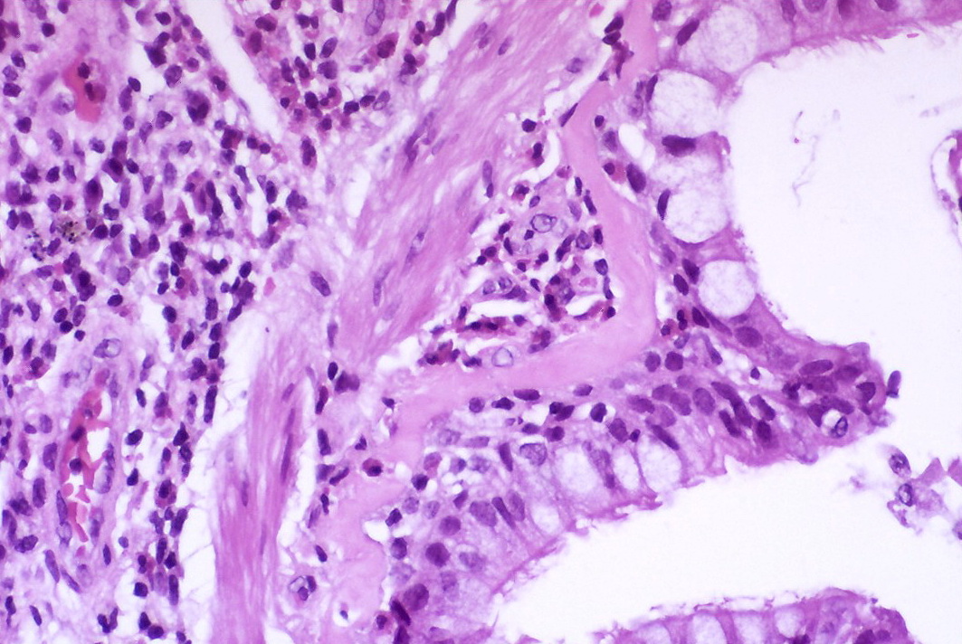 Asthma — airway remodeling + eosinophilic inflammation — Bronchial wall with goblet cell metaplasia, H&E stain