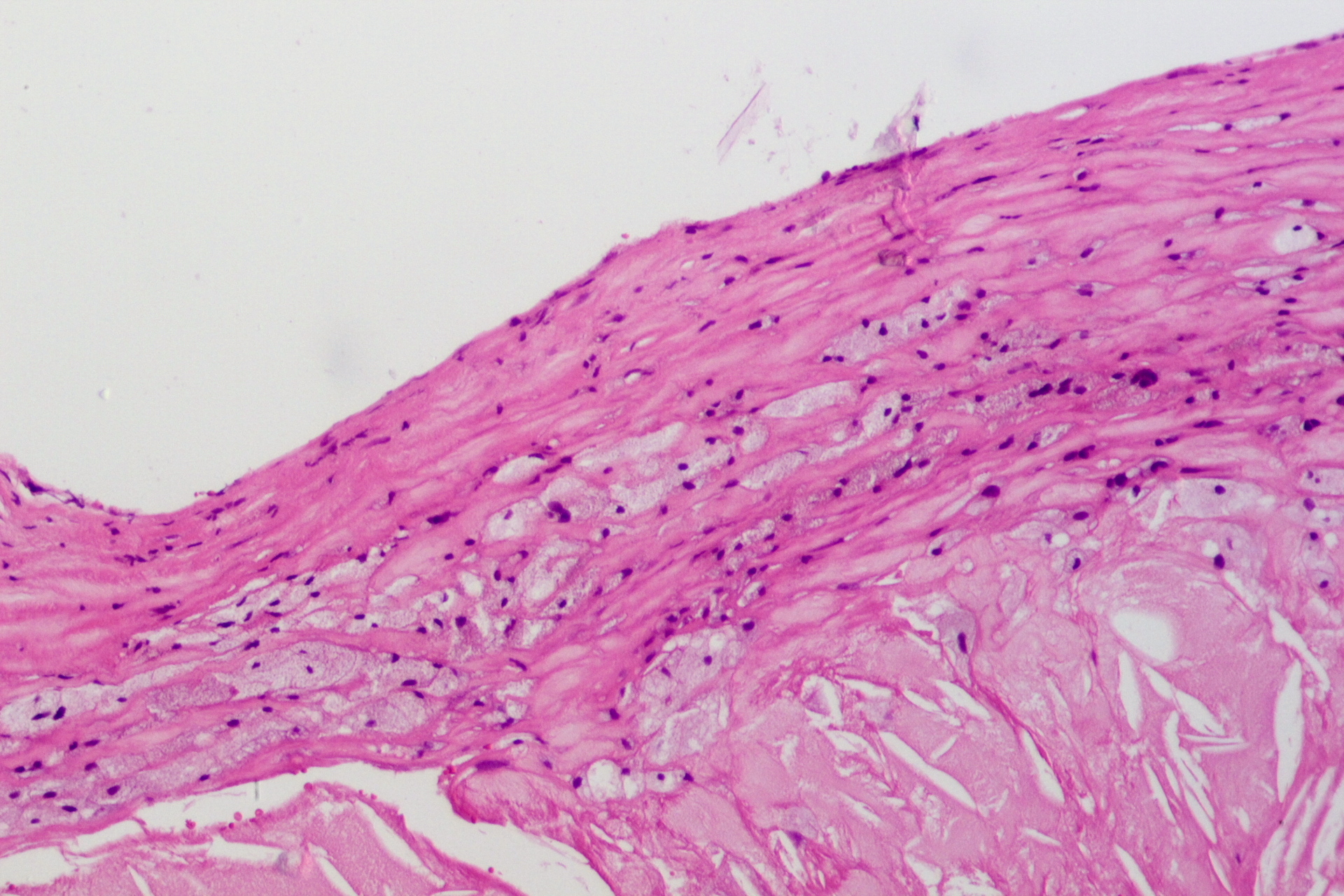 Atherosclerosis — fibrous cap + lipid core — Intima with atheroma, H&E stain