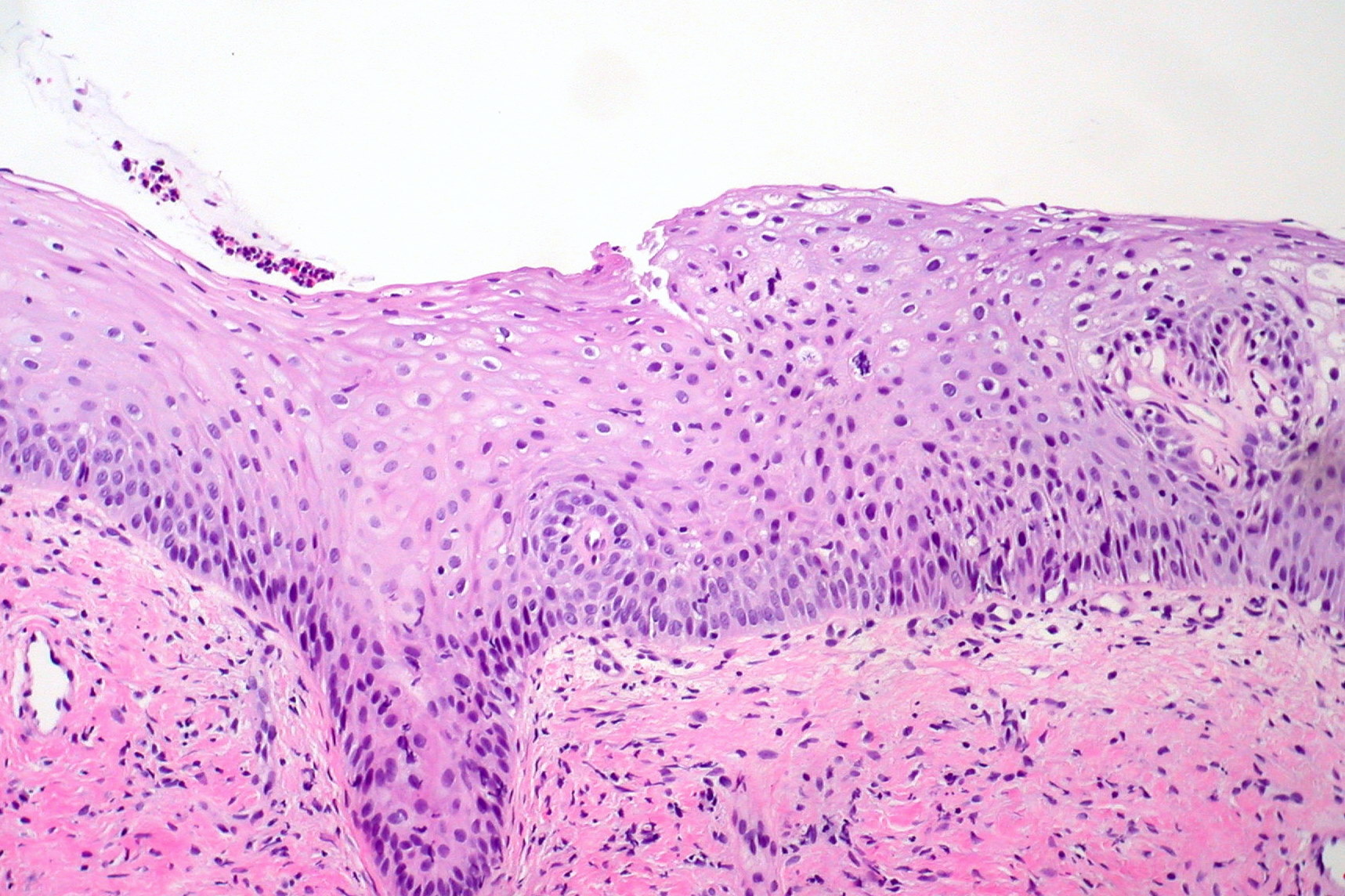 Cervical intraepithelial neoplasia (CIN 2 / HSIL) — Squamous epithelium with HPV-driven dysplasia, H&E stain