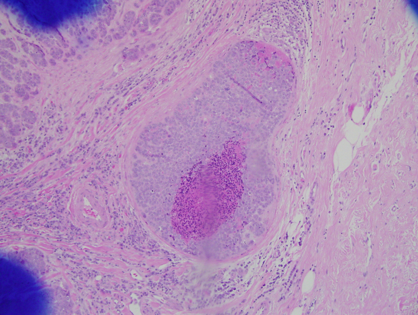 Comedo DCIS — high-grade ductal carcinoma in situ — Mammary duct with neoplastic epithelium, H&E stain