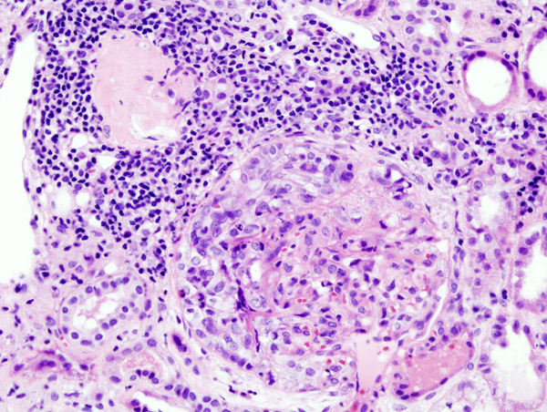 Crescentic glomerulonephritis (RPGN) — Renal cortex â€” glomerulus, PAS stain