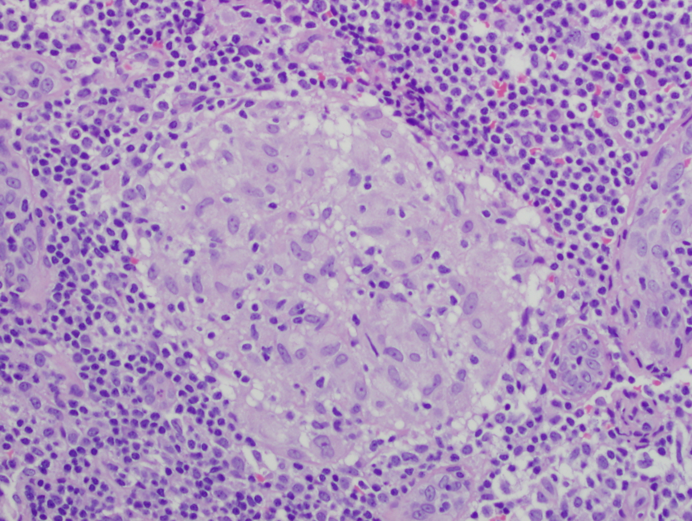Granulomatous inflammation â€” non-caseating (sarcoid pattern) — Granuloma, H&E stain