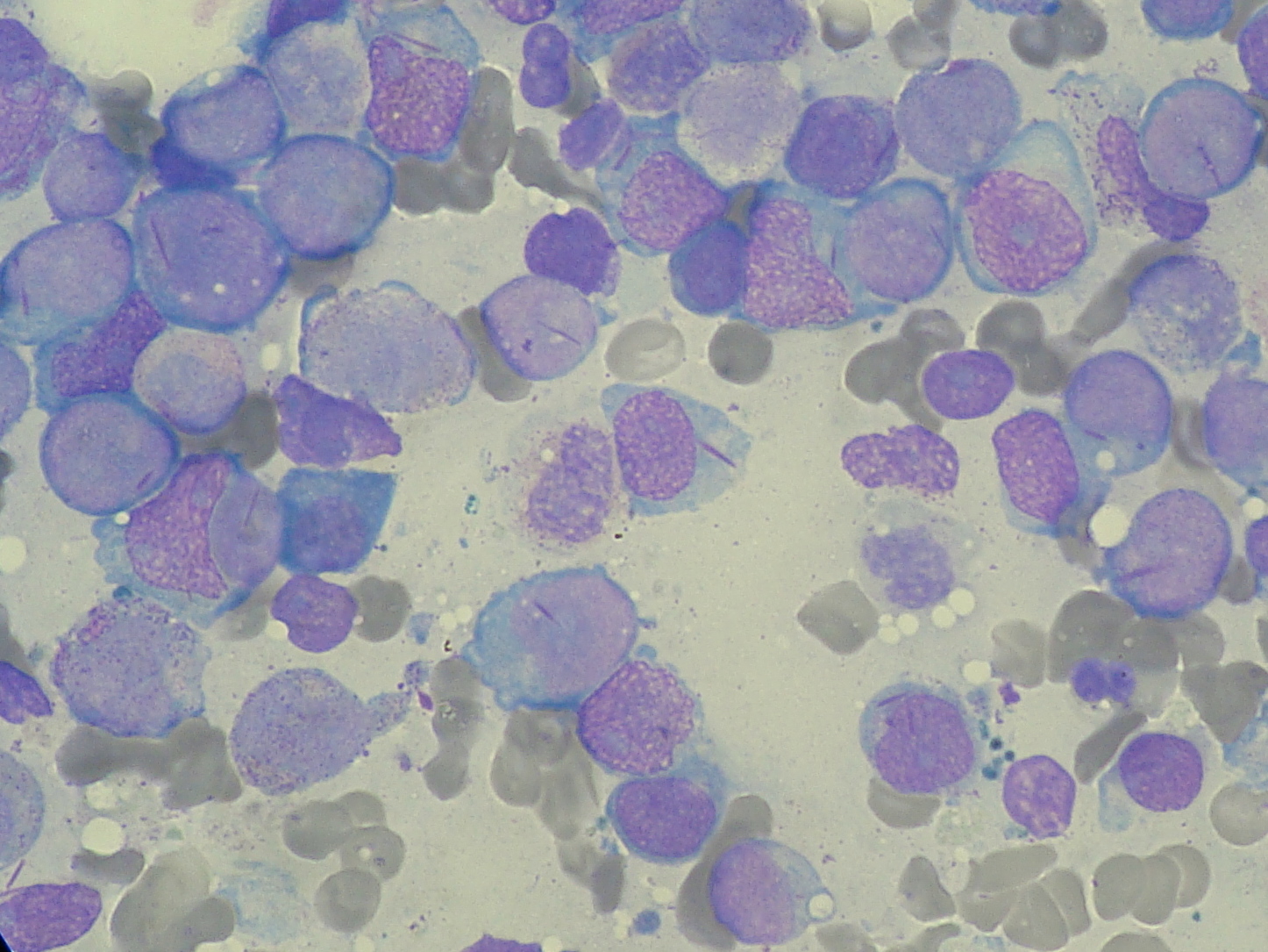 Peripheral smear â€” AML with Auer rods — Blood smear, Wright-Giemsa stain
