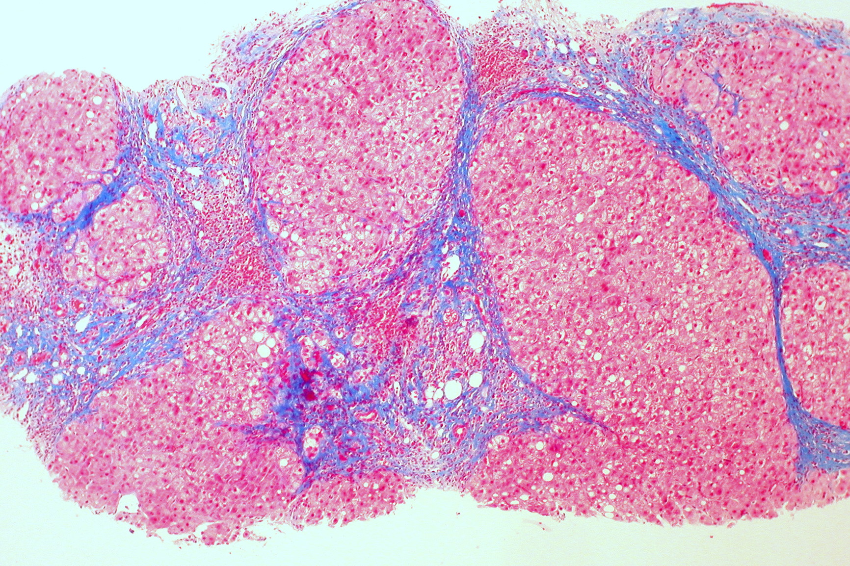 Liver cirrhosis — regenerative nodules + bridging fibrosis (Trichrome) — Hepatic parenchyma with fibrosis, Masson trichrome stain