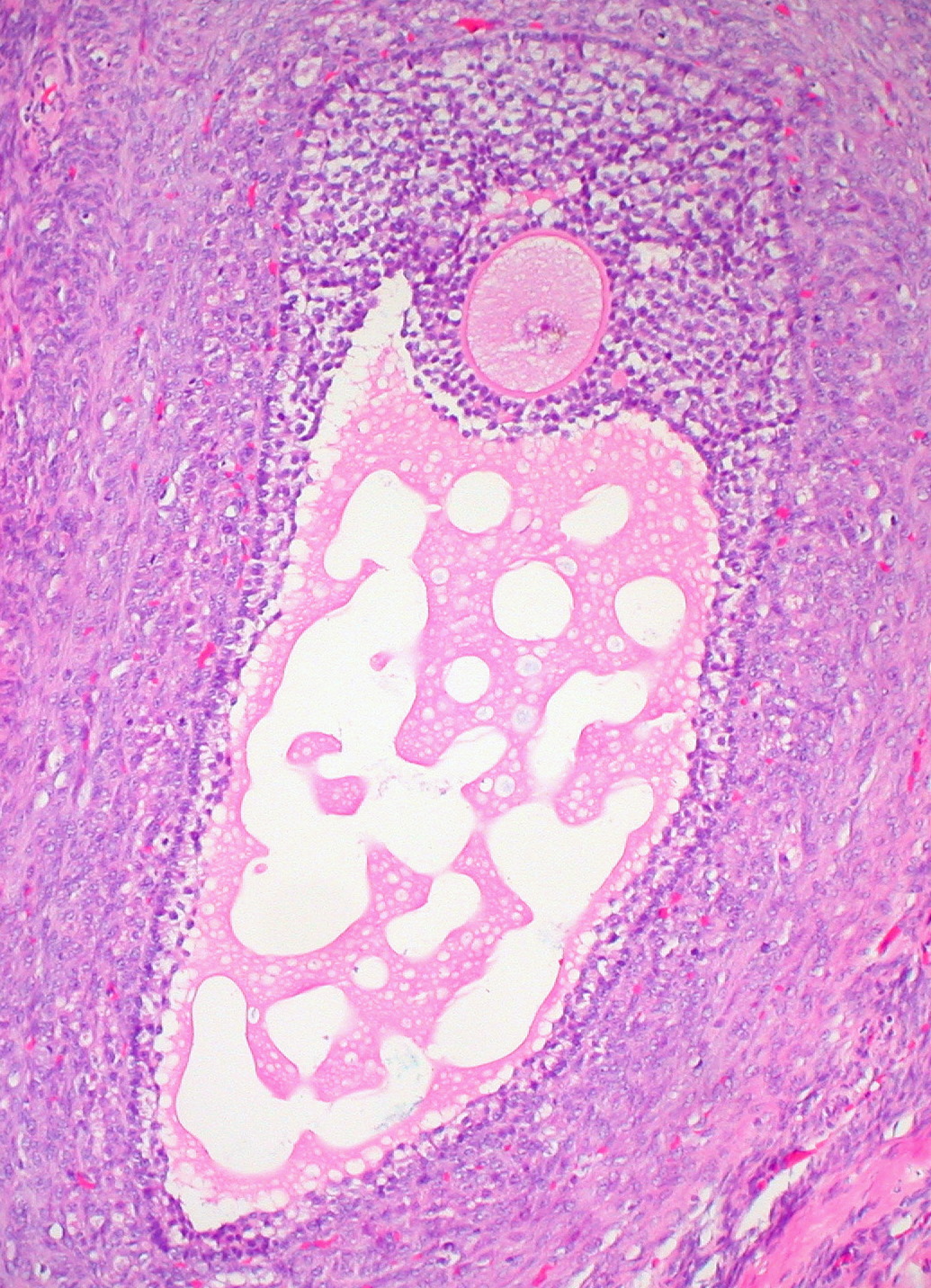 Ovary — Graafian (mature) follicle — Ovarian cortex with mature follicle, H&E stain
