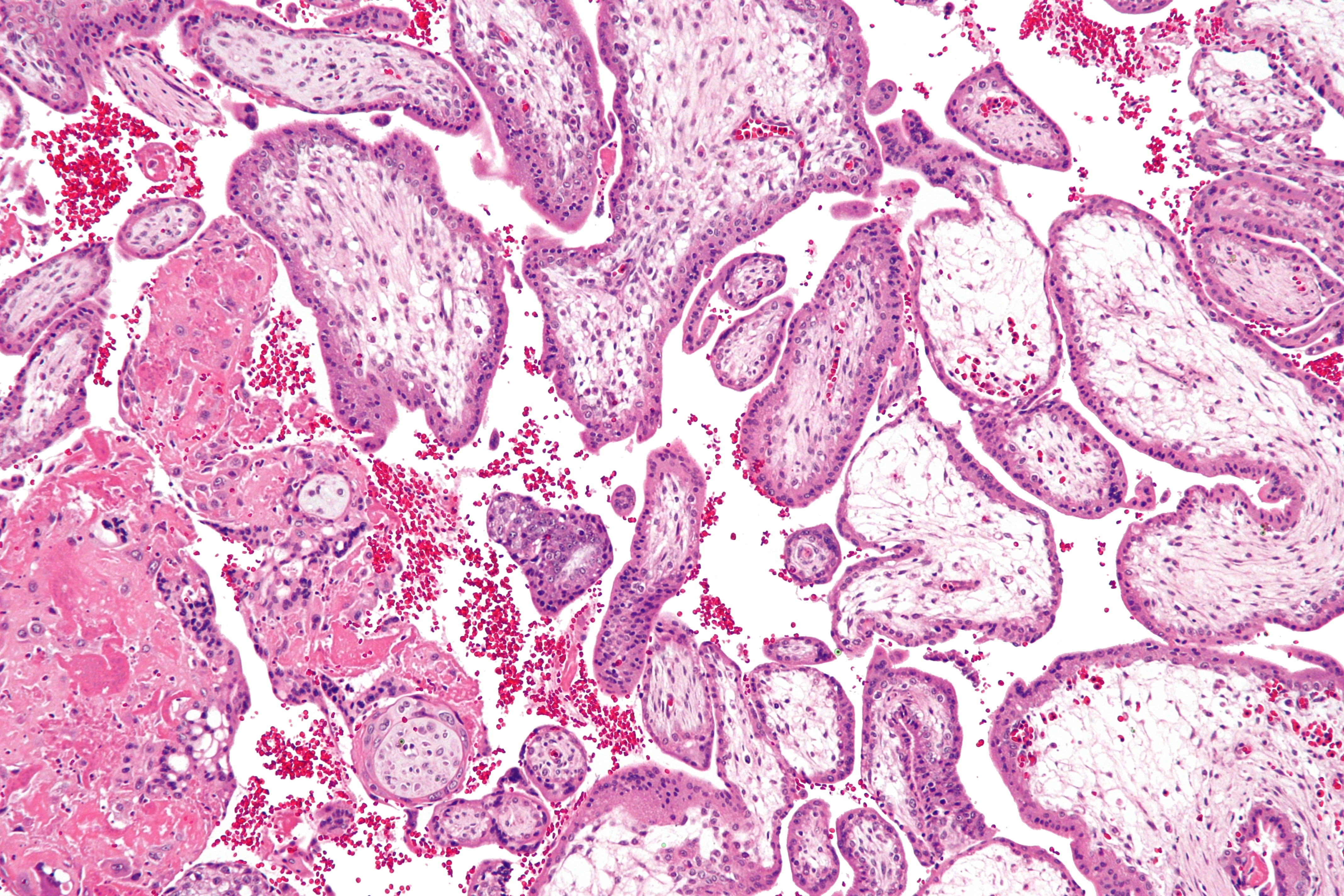 Placenta — chorionic villi with syncytiotrophoblast — Chorionic villus, H&E stain