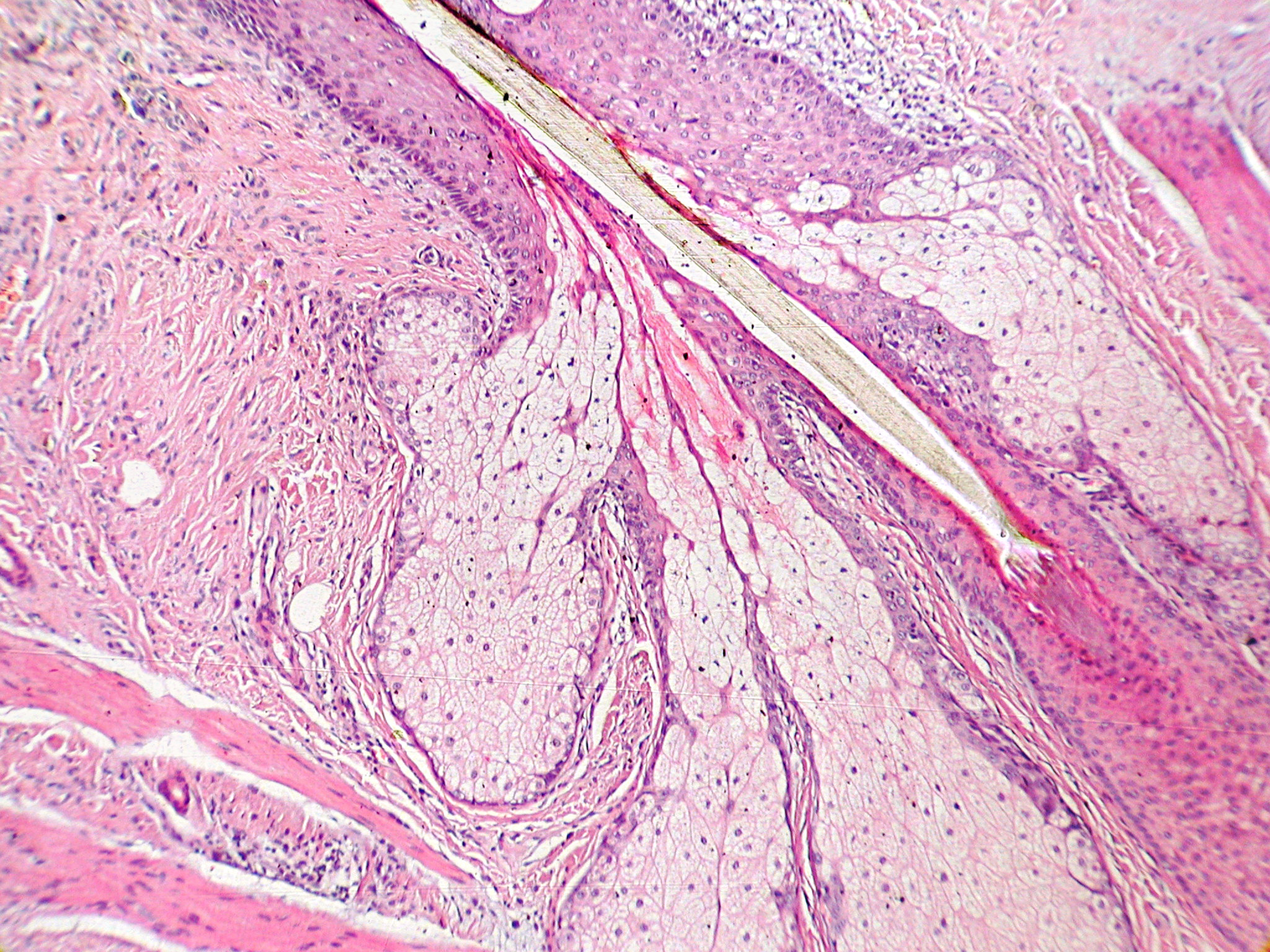 Skin — sebaceous glands inserting into hair shaft — Pilosebaceous unit, H&E stain