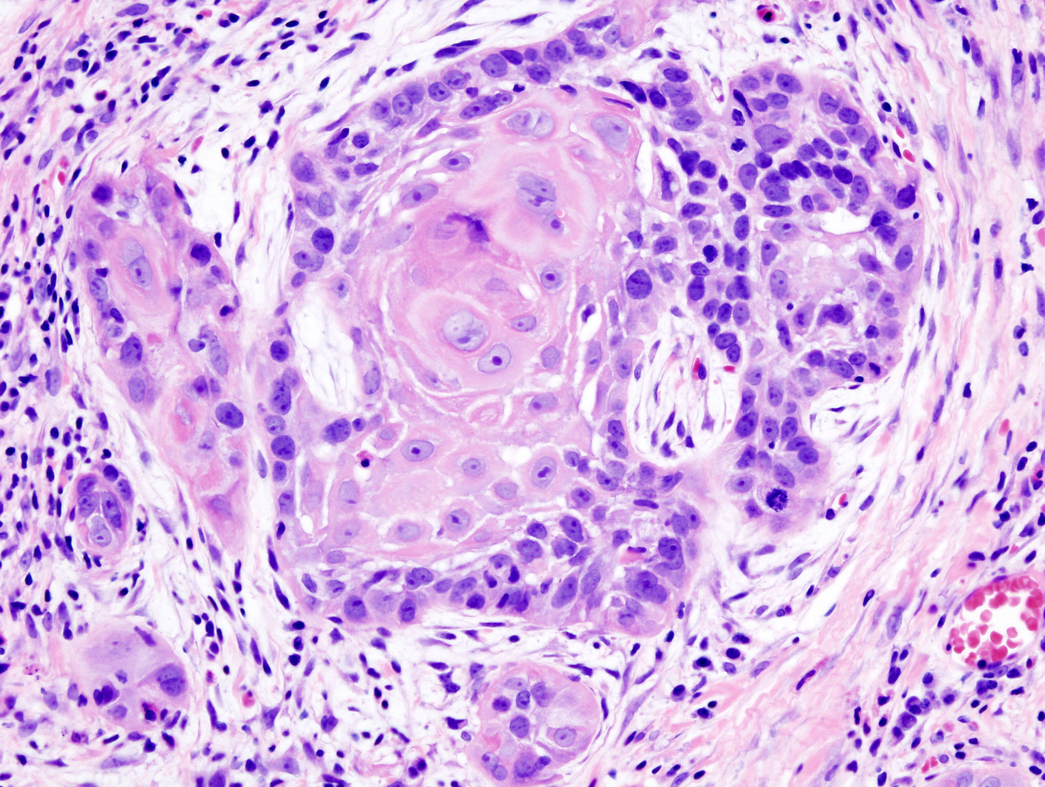 Squamous cell carcinoma with keratin pearls — Squamous epithelium, H&E stain