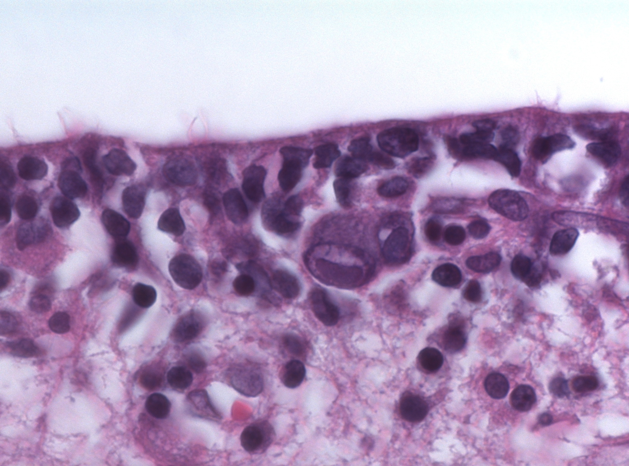 Cytomegalovirus (HHV-5) — Enveloped dsDNA herpesvirus (β-herpesvirus)