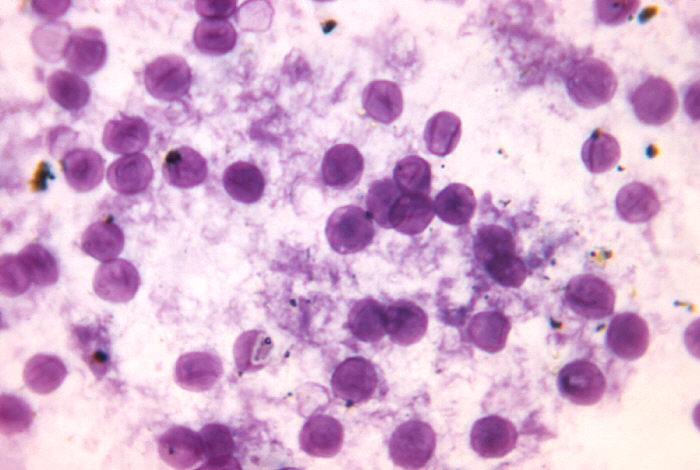 Pneumocystis jirovecii — Atypical fungus (extracellular)